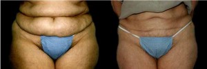 before and after tummy tuck photo