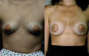 Before & After Photo: Breast Augmentation - Patient 3