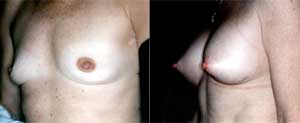 Before & After Photo: Breast Augmentation - Patient 4