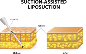 liposuction long island | Dr. Elliot Duboys Suffolk County 