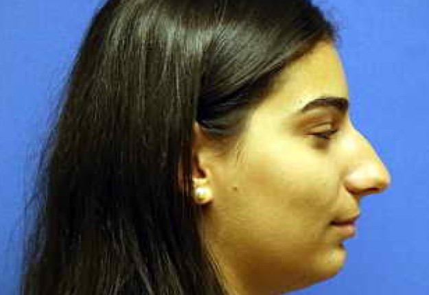 How To Get Insurance To Pay For Eyelid Surgery Contour How To Get Insurance To Pay For Eyelid Surgery Contour
